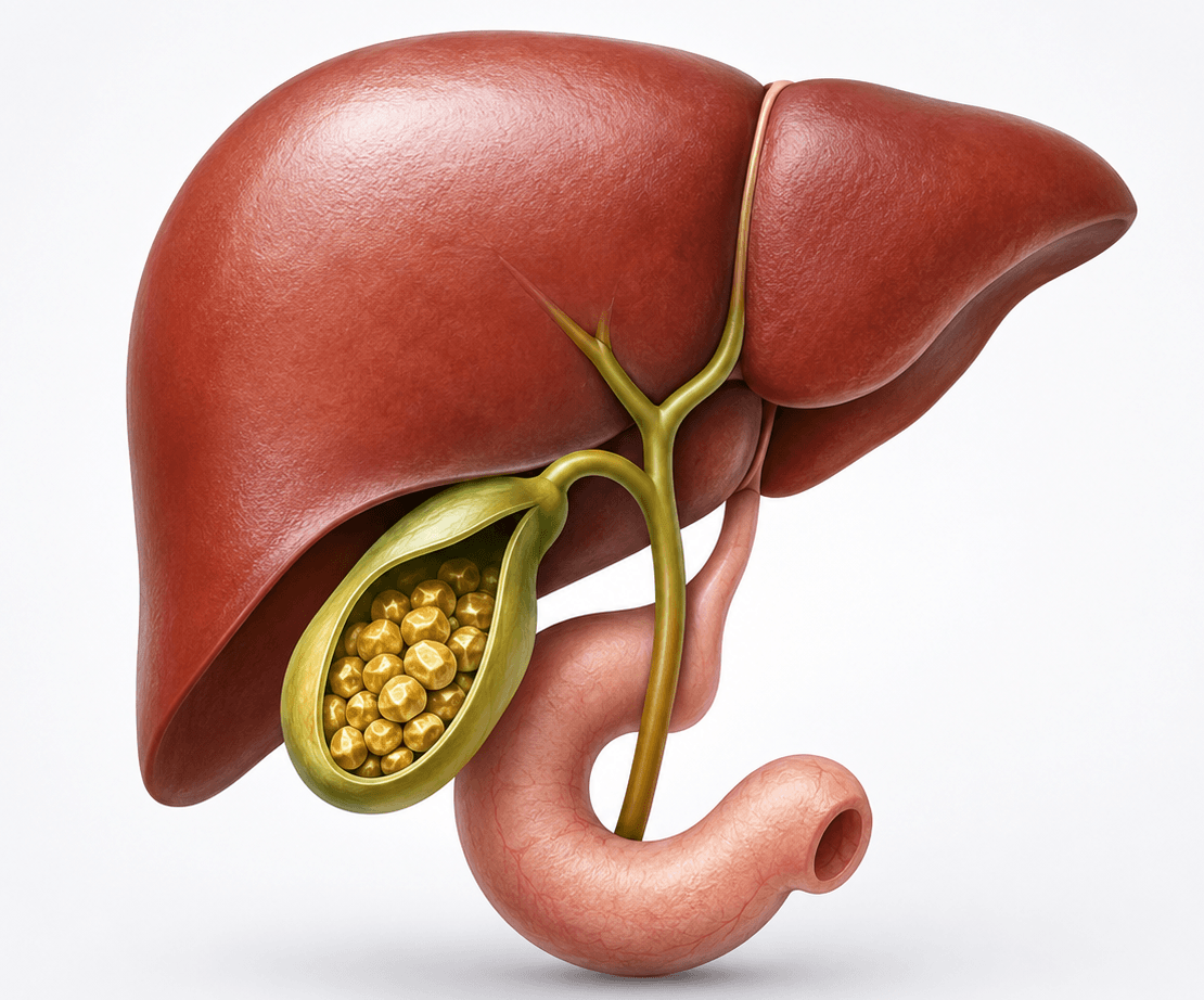 Gallbladder Stones surgery
