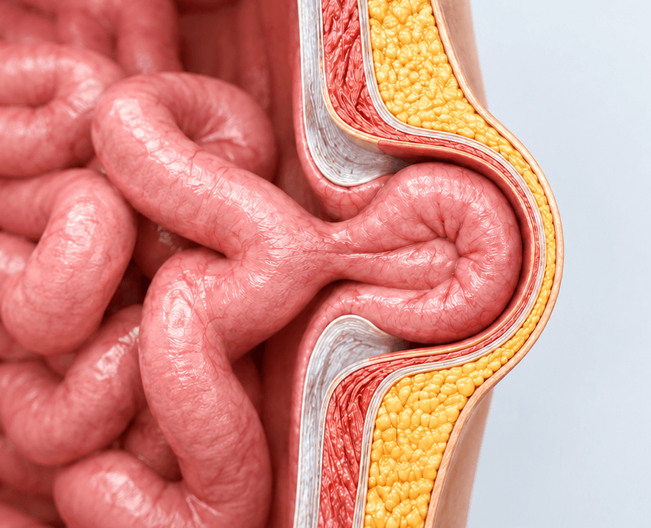 Hernia surgery