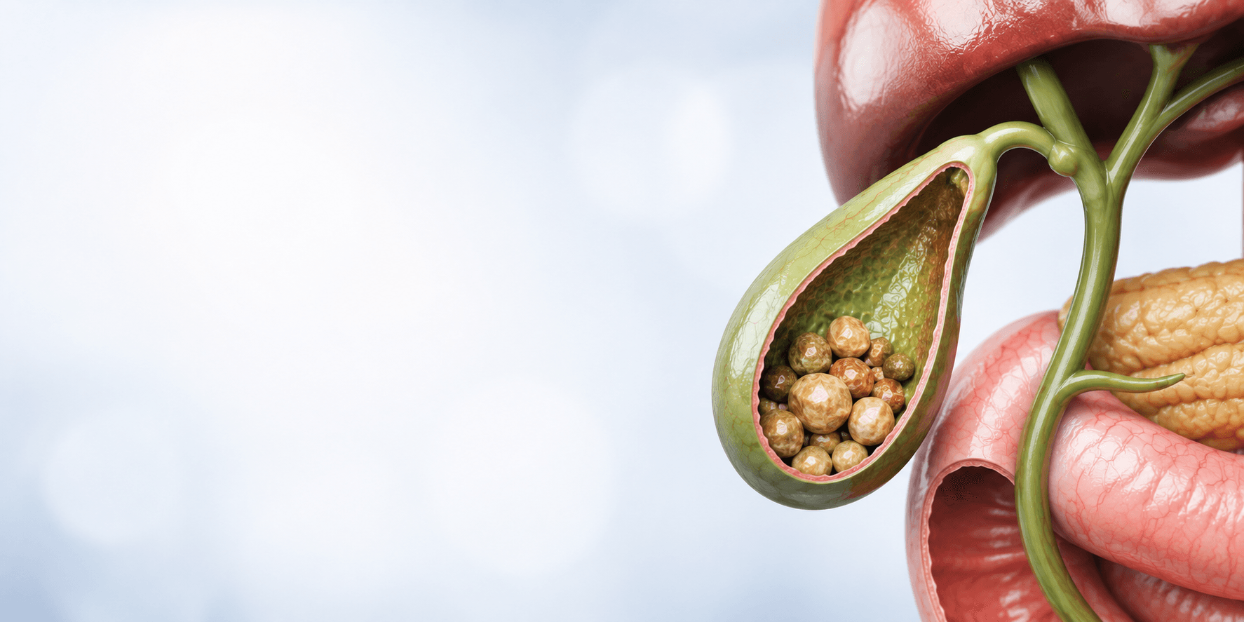 Gallbladder Stones