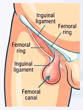 Femoral Hernia