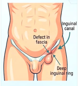 Inguinal Hernia
