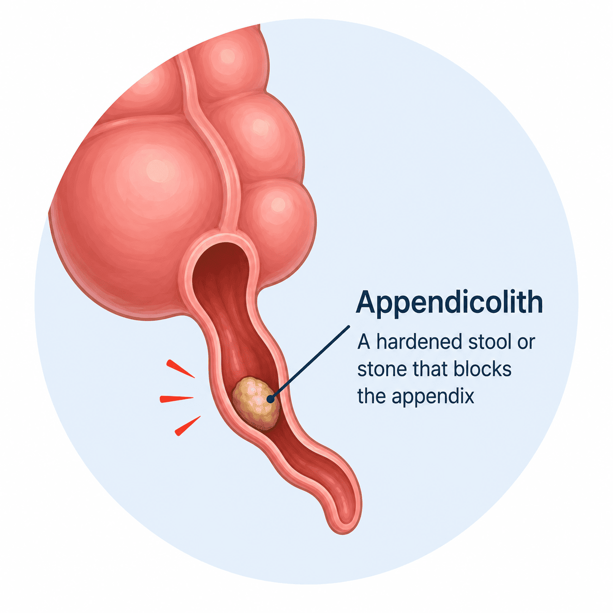 Appendicolith