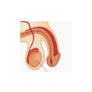 Hydrocele
