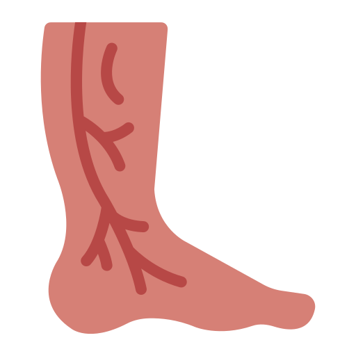 Varicose Veins