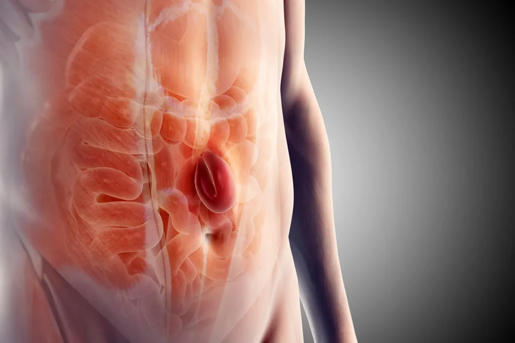 Hernia Surgery in Vizag