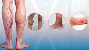 Are-Varicose-Veins-Dangerous-1024x576.jpeg